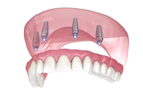 Maxillary prosthesis with gum All on 4 system supported by implants. Illustrazione stock
