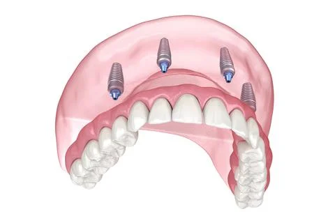 Maxillary prosthesis with gum All on 4 system supported by implants. Stock Illustration