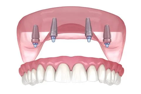 Maxillary prosthesis with gum All on 4 system supported by implants. Stock-Illustration