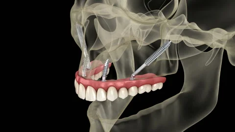 Maxillary prosthesis supported by zygomatic implants. Medically accurate 3D a Stock Footage 122149646