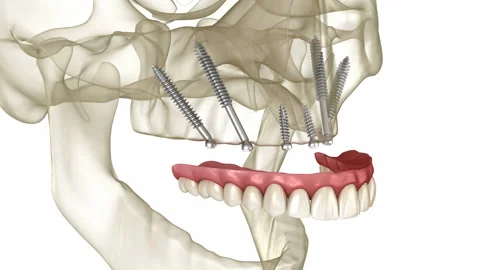 Maxillary prosthesis supported by zygomatic implants. Stock Footage 204140664