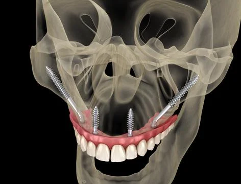 Maxillary prosthesis supported by zygomatic implants. Medically accurate 3D Stock Illustration