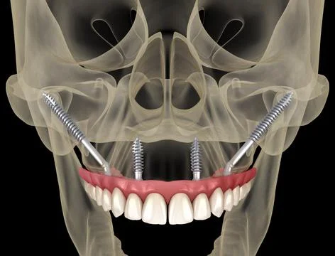 Maxillary prosthesis supported by zygomatic implants. Medically accurate 3D Stock Illustration