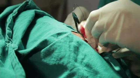 Maxillofacial surgery. Removing mole. Stitching, sting with needle, close up. Stock Footage 52706609