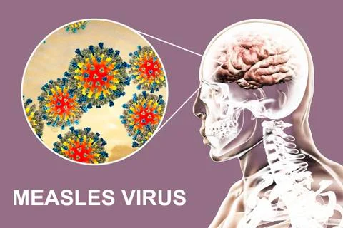 Measles-induced encephalitis Stock Illustration