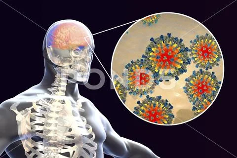 Measles-induced encephalitis, medical concept Stock Illustration