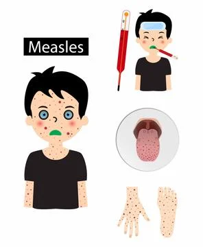 Measles, spots may form inside the mouth after the start of symptoms Stock Illustration