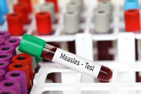 Measles test, blood sample to analyze in the laboratory Foto stock
