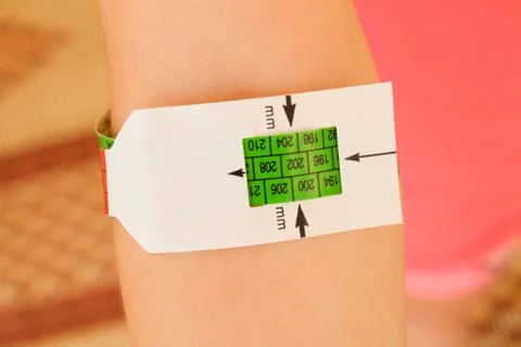 Measuring malnutrition using strap MUAC mid-upper-arm-circumference Stock Photos