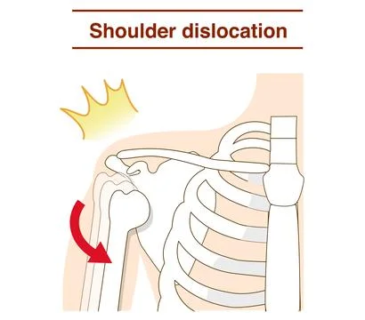 Mechanism of shoulder joint dislocation Stock-Illustration