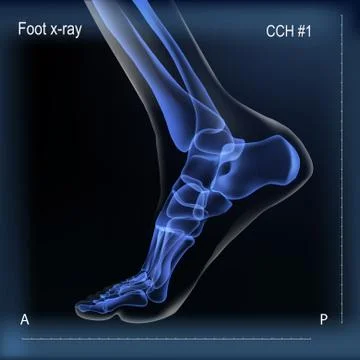 Medial view x ray of bones the of foot. Stock Illustration