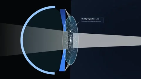 Medical Animation Explaining Cataract Pathogenesis And Eye Vision Impairment Stock Footage 340470151