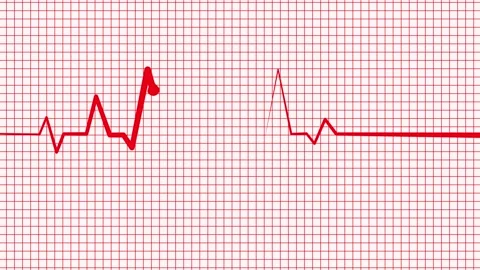 Medical Diagnostics Animation Featuring Heartbeat Waveform Signal Stock Footage 337064710