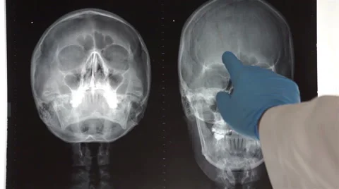 Medical Doctor Pointing to Head X-ray Stock Footage
