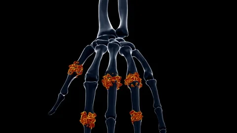 Medical dynamic video materials on bone and joint diseases Stock Footage 343202323
