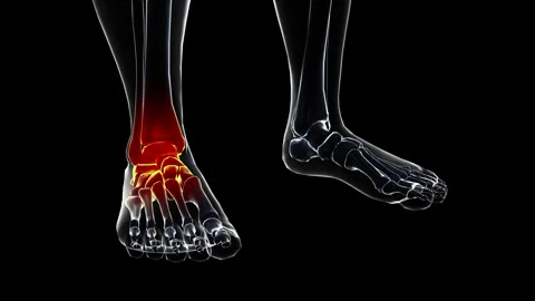 Medical dynamic video materials on bone and joint diseases Stock Footage 343202916