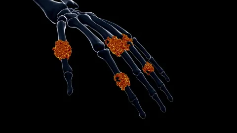 Medical dynamic video materials on bone and joint diseases Stock Footage 343203455