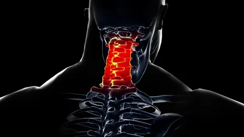 Medical dynamic video materials on bone and joint diseases Stock Footage 343203733