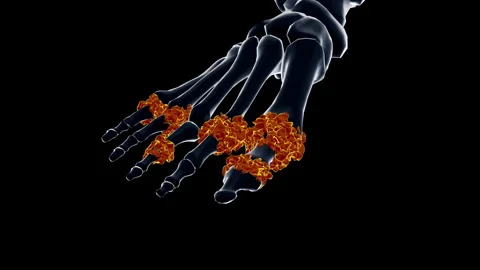 Medical dynamic video materials on bone and joint diseases Stock Footage 343203748