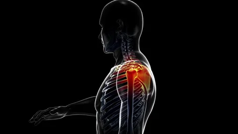 Medical dynamic video materials on bone and joint diseases Stock Footage 343348008