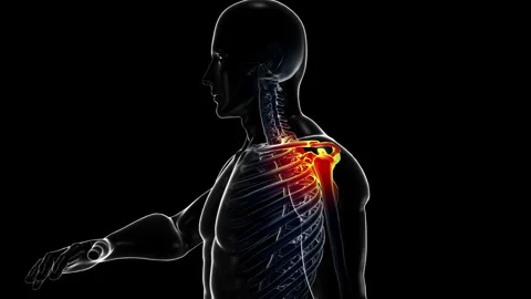 Medical dynamic video materials on bone and joint diseases Stock Footage 343348010