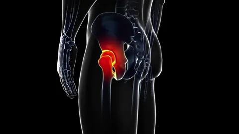 Medical dynamic video materials on bone and joint diseases Stock Footage 343348229