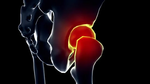 Medical dynamic video materials on bone and joint diseases Stock Footage 343469074