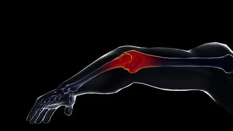 Medical dynamic video materials on bone and joint diseases-arm Stock Footage 343763810