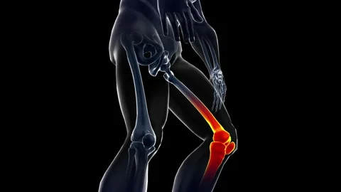 Medical dynamic video materials on bone and joint diseases-knee Stock Footage 343927487