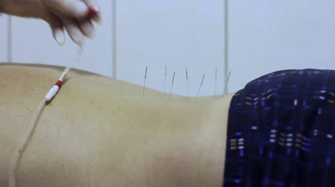 Medical Electro Acupuncture Stock Footage 62760874