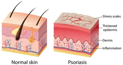 Medical Illustration Comparing Normal Human Skin and Psoriasis Cross Sections Stock Illustration
