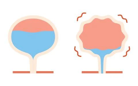 Medical illustration of overactive bladder, normal bladder vs. Stock Illustration