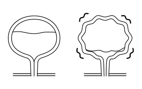 Medical illustration of overactive bladder, normal bladder vs. Stock Illustration