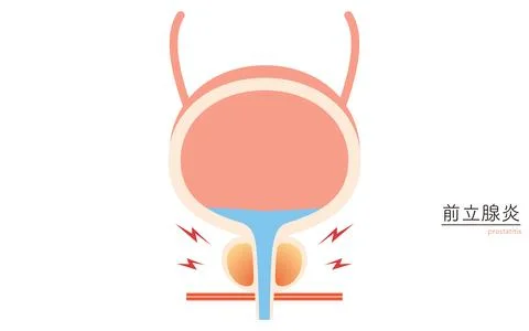 Medical Illustration of Prostate, Prostatitis 库存插图