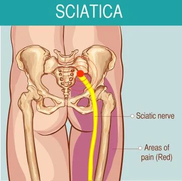 Medical illustration of symptoms of sciatica Stock Illustration
