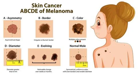 Medical Infographic Explaining the ABCDE Rule for Skin Cancer Melanoma Stock Illustration