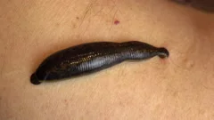Medical leech on the human body drink bl, Stock Video