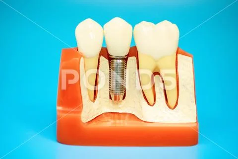 Medical model of the jaw with false teeth on a pin on blue background Stock Photos