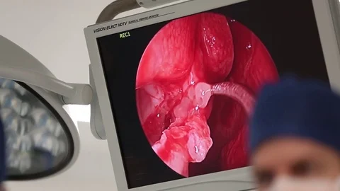 Medical Operation HD Stock Footage 72093413