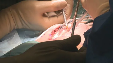 Medical operation on the spine Stock Footage