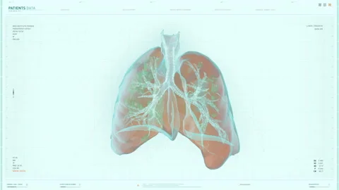 Medical Research Of Lungs Condition In Computer Software To Diagnose Covid-19 Stock Footage 211853641