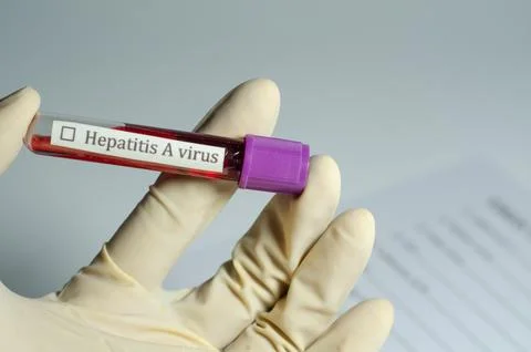 Medical Sample Held for Virus Test Report on Hepatitis a Stock Photos