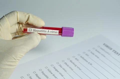 Medical Sample Held for Virus Test Report on Hepatitis a Stock Photos