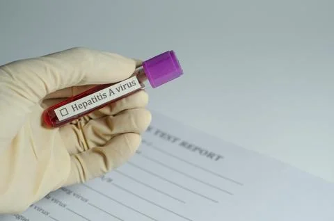 Medical Sample Held for Virus Test Report on Hepatitis a Stock Photos
