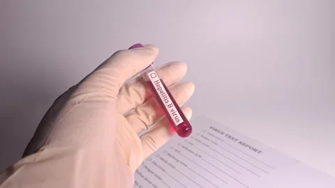 Medical Sample Test for Hepatitis B Virus in Laboratory Stock Footage 338040413