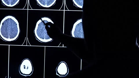 Medical scientist scrolls and points at CT, MRI brain scan images on a screen. 스톡 동영상 147980966