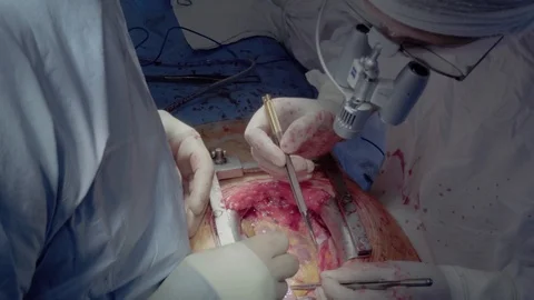 Medical staff of the operating unit do heart surgery Stock Footage 104922164