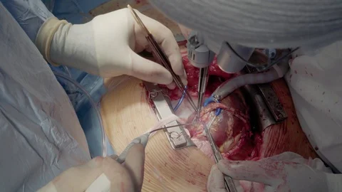 Medical staff of the operating unit do heart surgery. Shunt installation Stock Footage 104923112