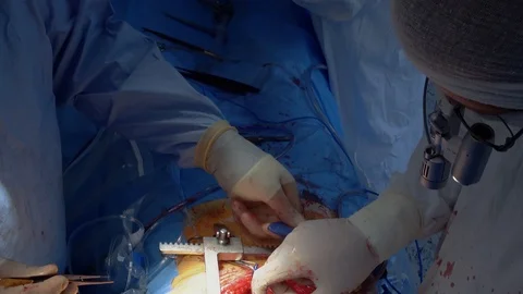 Medical staff of the operating unit do heart surgery. Preparation for the Stock Footage 104923119