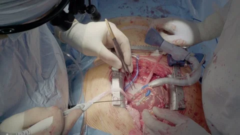 Medical staff of the operating unit do heart surgery. Shunt installation Stock Footage 104923157